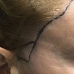 Receding Hairline in Women