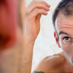 What causes hair loss?