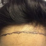 Avoid Plastic Surgery, Lower Your Hairline