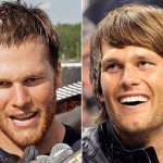 Tom Brady Inspired My Hair Transplant!