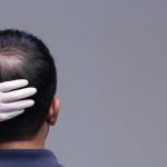 What is the medical management of hair loss?