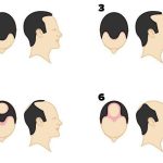 The Stages of Hair Loss